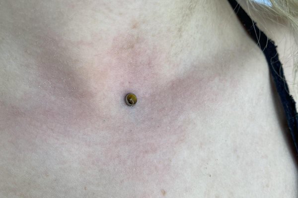 Microdermal13
