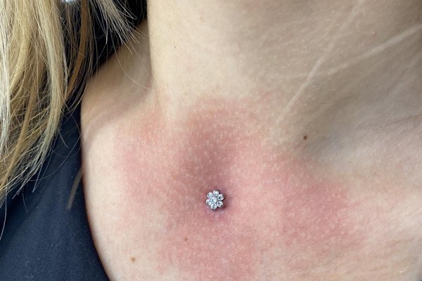Microdermal17